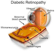 Diabetic-Retinopathy