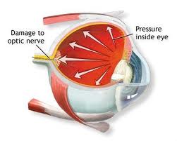 Glaucoma